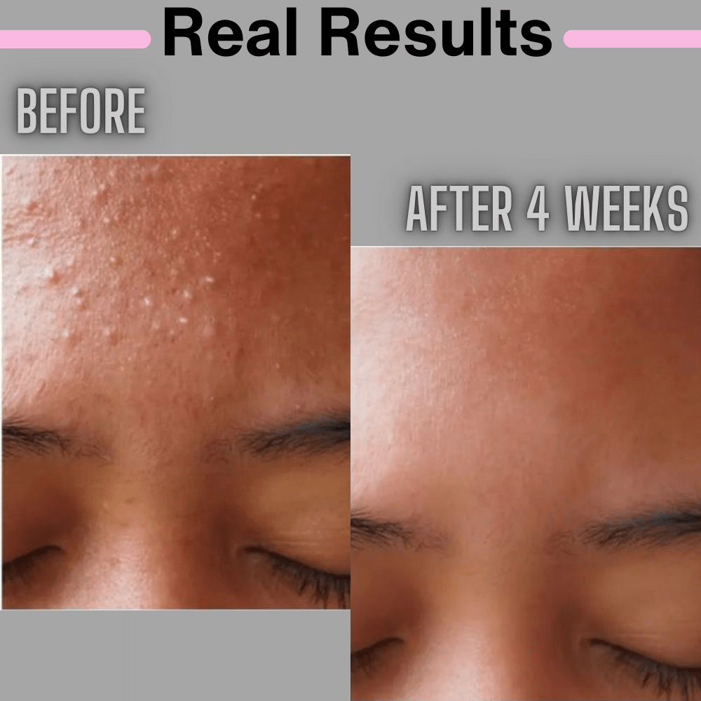 Anti Acne Kit for Active Acne Pimples Get Clean Clear Skin Beauhancestore