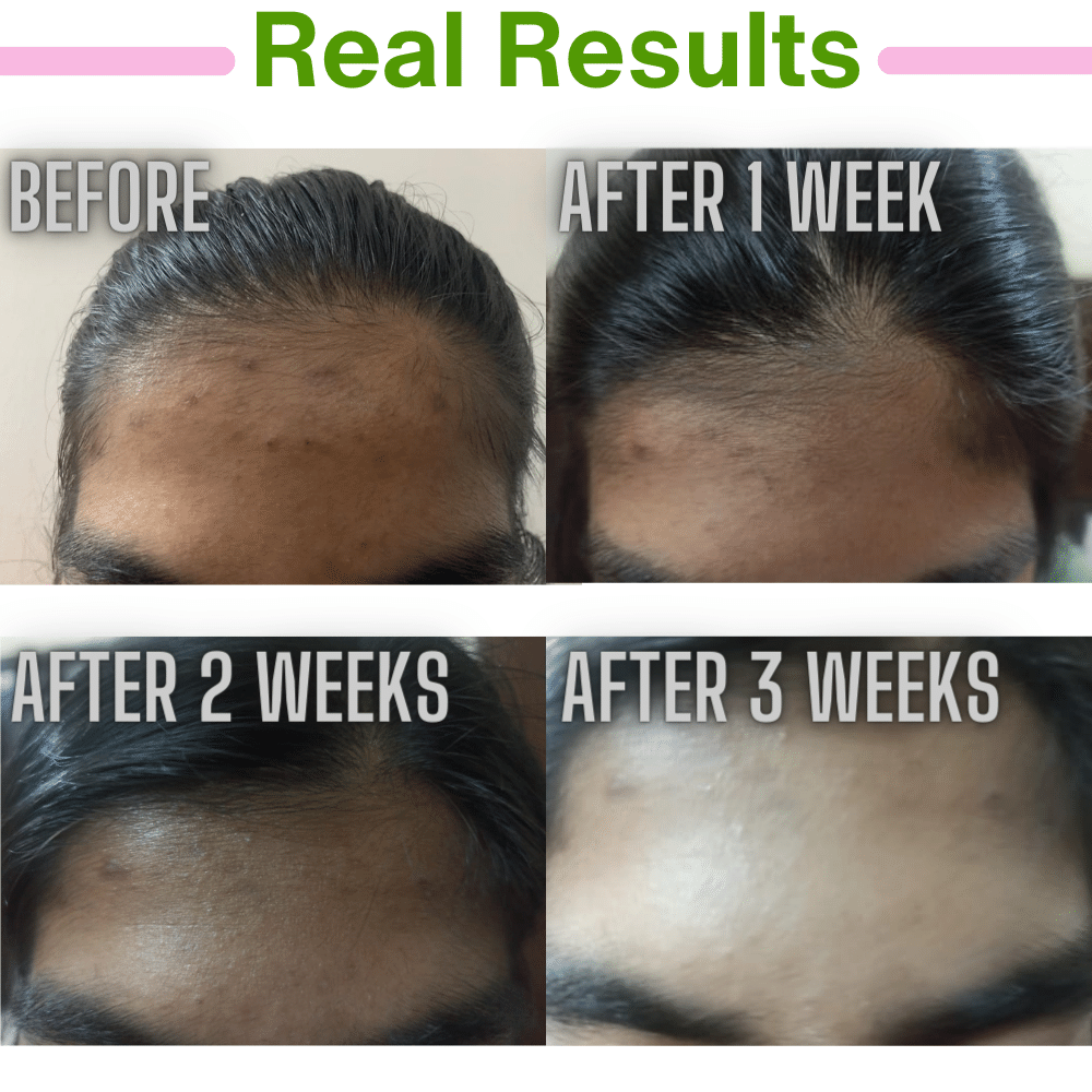 Anti Acne Routine - From Cure To Prevention - For Acne Prone Skin